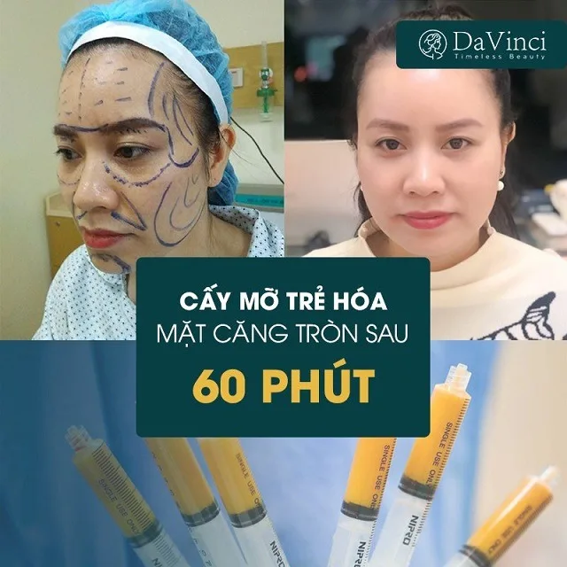 Cấy mỡ trẻ hoá mắt giá bao nhiêu? Cấy mỡ trẻ hoá mắt có an toàn không? Cấy mỡ trẻ hoá mắt giá bao nhiêu? Cấy mỡ trẻ hoá mắt có an toàn không?