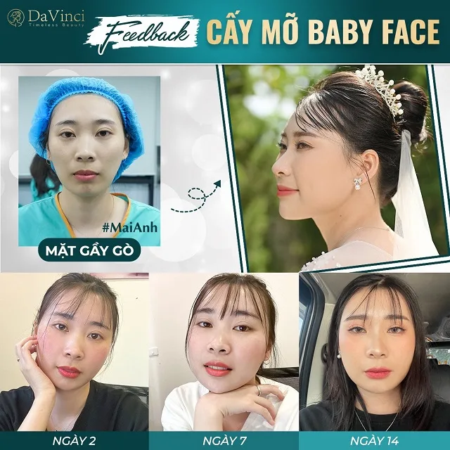 Cấy mỡ trẻ hoá mắt giá bao nhiêu? Cấy mỡ trẻ hoá mắt có an toàn không? Cấy mỡ trẻ hoá mắt giá bao nhiêu? Cấy mỡ trẻ hoá mắt có an toàn không?