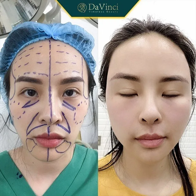 Cấy mỡ trẻ hoá mắt giá bao nhiêu? Cấy mỡ trẻ hoá mắt có an toàn không? Cấy mỡ trẻ hoá mắt giá bao nhiêu? Cấy mỡ trẻ hoá mắt có an toàn không?