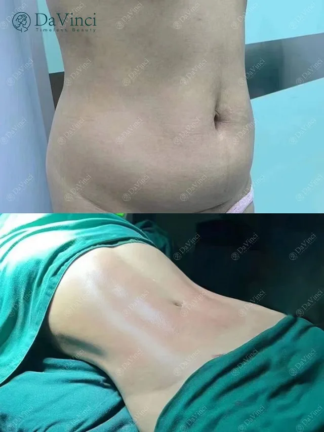 Hút mỡ tạo cơ bụng giá bao nhiêu? Hút mỡ tạo cơ bụng có nguy hiểm không? 