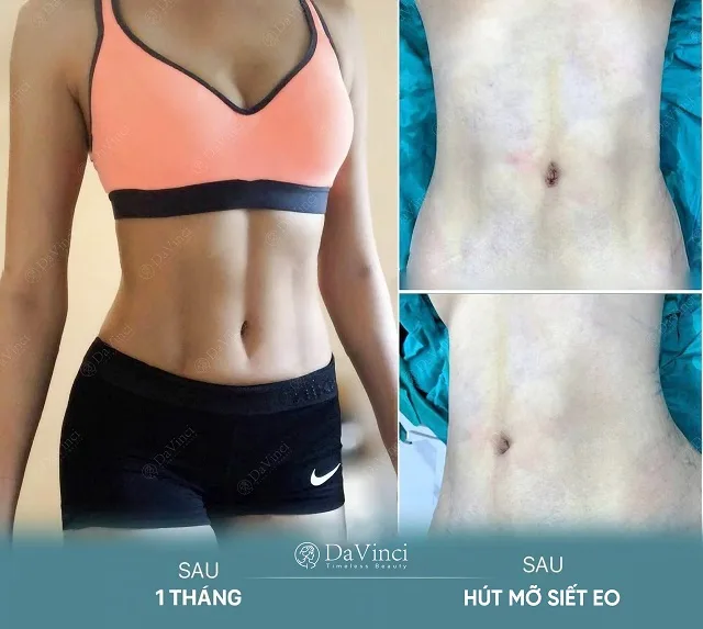 Hút mỡ tạo cơ bụng giá bao nhiêu? Hút mỡ tạo cơ bụng có nguy hiểm không? 