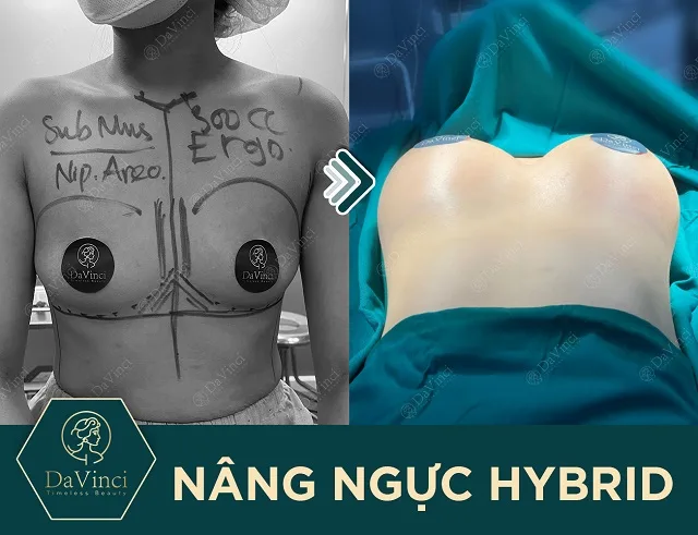Nâng ngực Hybrid giá bao nhiêu? Có duy trì được lâu ? Nâng ngực Hybrid giá bao nhiêu? Có duy trì được lâu ?