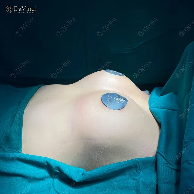 Nâng ngực Hybrid giá bao nhiêu? Có duy trì được lâu ? Nâng ngực Hybrid giá bao nhiêu? Có duy trì được lâu ?