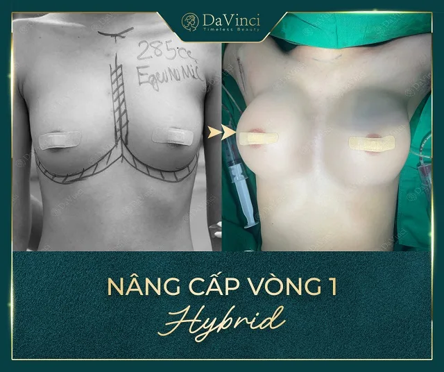 Nâng ngực Hybrid giá bao nhiêu? Có duy trì được lâu ? Nâng ngực Hybrid giá bao nhiêu? Có duy trì được lâu ?