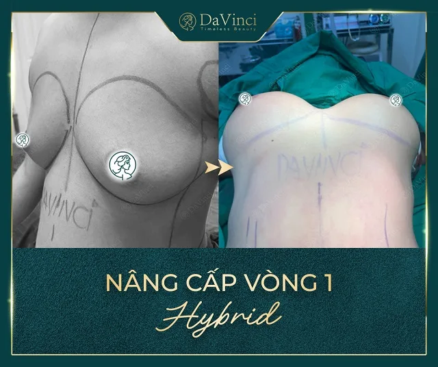 Nâng ngực Hybrid giá bao nhiêu? Có duy trì được lâu ? Nâng ngực Hybrid giá bao nhiêu? Có duy trì được lâu ?