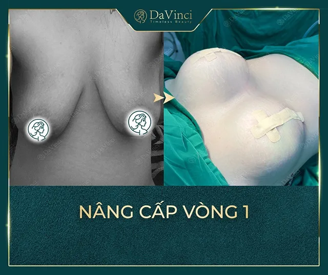 Nâng ngực nội soi giá bao nhiêu? Nâng ngực nội soi ở đâu tốt an toàn? 