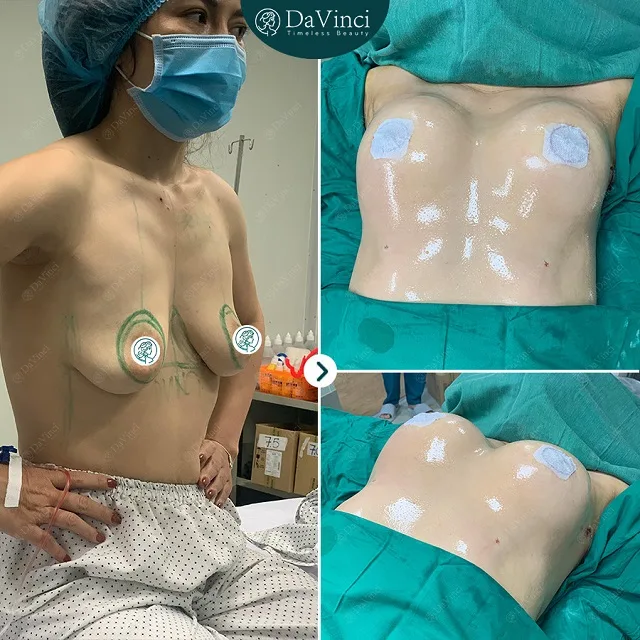 Nâng ngực nội soi giá bao nhiêu? Nâng ngực nội soi ở đâu tốt an toàn? 