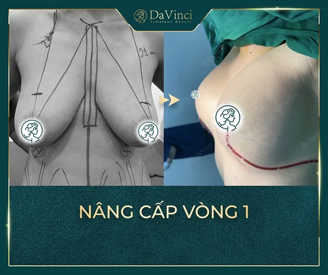 Nâng ngực nội soi giá bao nhiêu? Nâng ngực nội soi ở đâu tốt an toàn? 