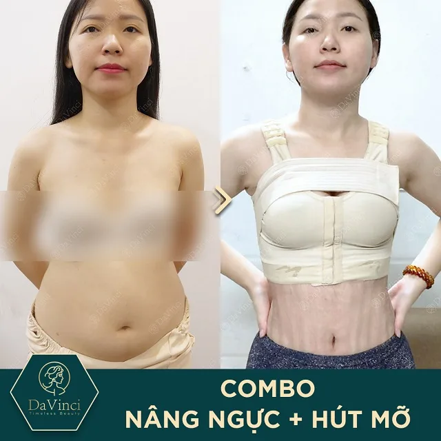 Hút mỡ bụng và nâng ngực nội soi có thực hiện cùng lúc được không? Hút mỡ bụng và nâng ngực nội soi có thực hiện cùng lúc được không?