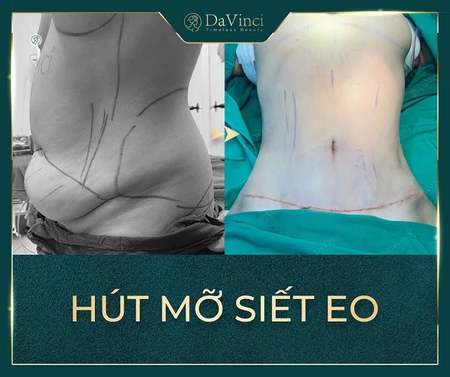 Hút mỡ bụng và nâng ngực nội soi có thực hiện cùng lúc được không? Hút mỡ bụng và nâng ngực nội soi có thực hiện cùng lúc được không?