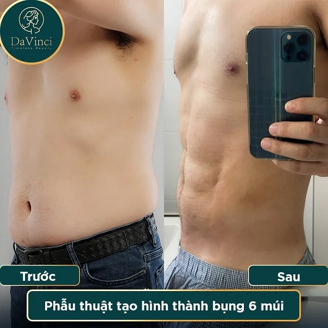 Phẫu thuật tạo bụng hình bụng 6 múi cho nam giới đẹp an toàn 