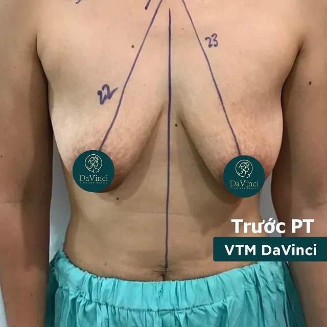Treo sa ngực trễ giá bao nhiêu? Làm ở đâu tốt an toàn và uy tín