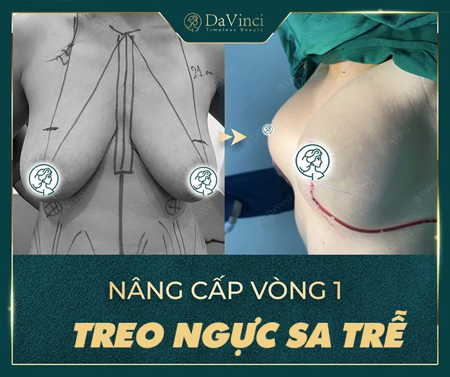 Treo sa ngực trễ giá bao nhiêu? Làm ở đâu tốt an toàn và uy tín