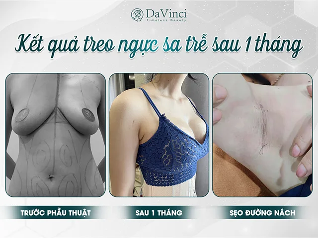 Treo sa ngực trễ giá bao nhiêu? Làm ở đâu tốt an toàn và uy tín