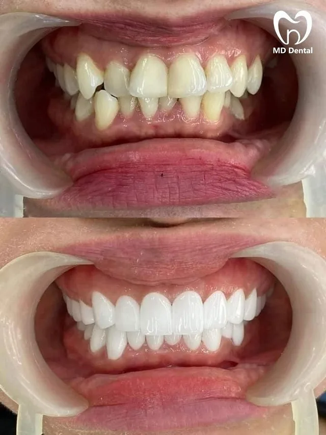 Bọc răng sứ giá bao nhiêu? Đối tượng và quy trình bọc răng sứ