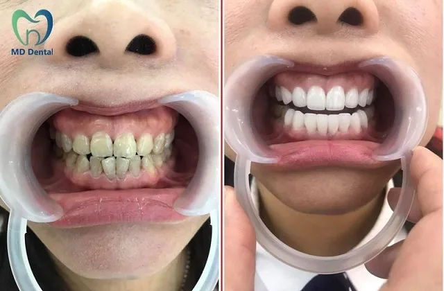 Bọc răng sứ giá bao nhiêu? Đối tượng và quy trình bọc răng sứ