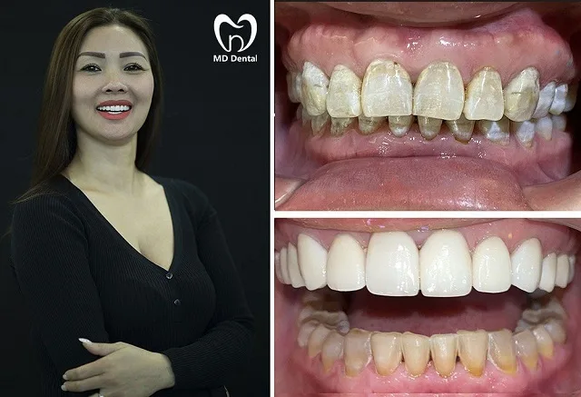 Dán sứ Veneer giá bao nhiêu? Dán sứ Veneer có bền không?