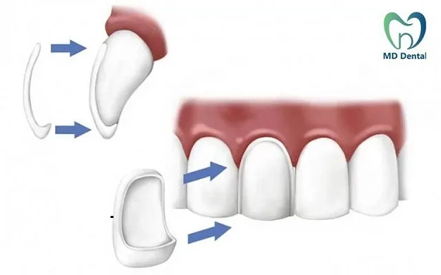 Dán sứ Veneer giá bao nhiêu? Dán sứ Veneer có bền không?