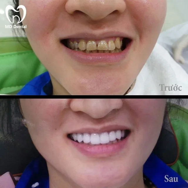 Dán sứ Veneer giá bao nhiêu? Dán sứ Veneer có bền không?