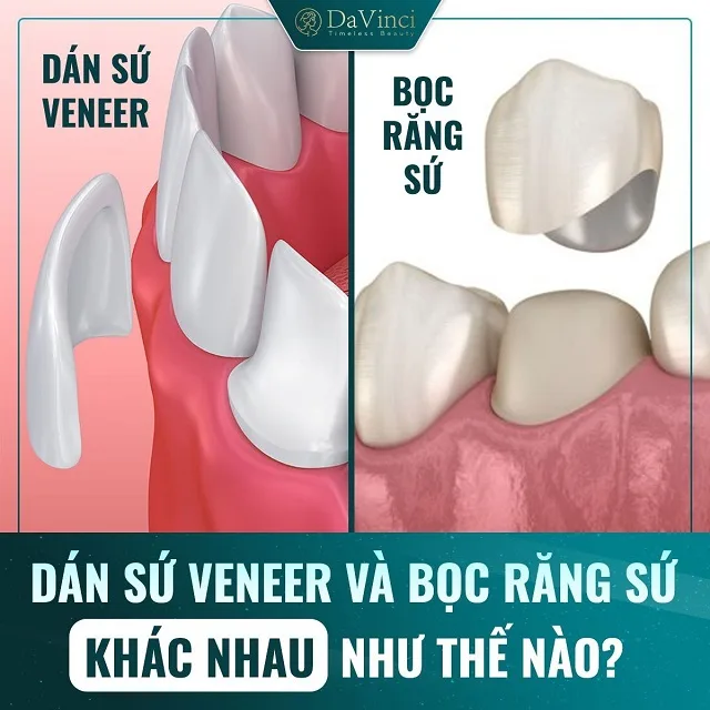 Dán sứ Veneer giá bao nhiêu? Dán sứ Veneer có bền không?