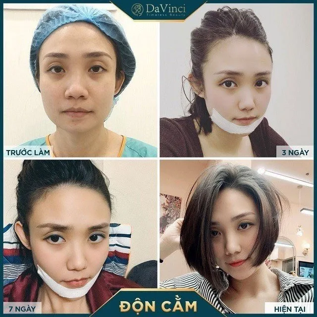 Độn cằm Vline Hàn Quốc có tốt không? Độn cằm Vline ở đâu uy tín? Độn cằm Vline Hàn Quốc có tốt không? Độn cằm Vline ở đâu uy tín?