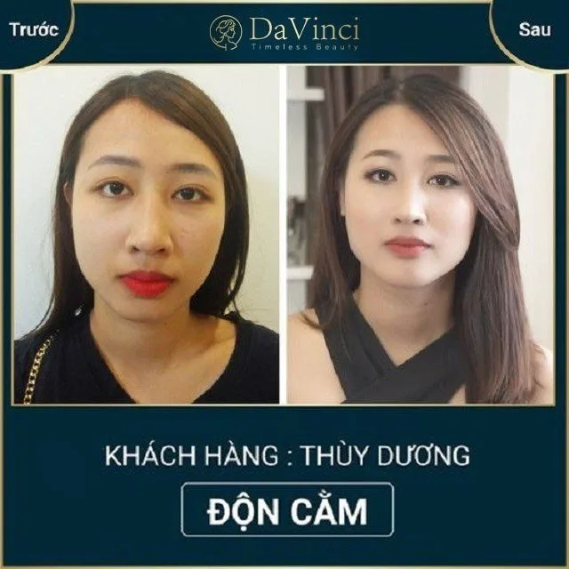Độn cằm Vline Hàn Quốc có tốt không? Độn cằm Vline ở đâu uy tín? Độn cằm Vline Hàn Quốc có tốt không? Độn cằm Vline ở đâu uy tín?