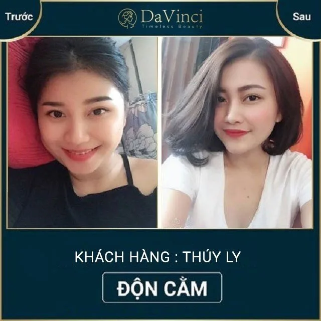 Độn cằm Vline Hàn Quốc có tốt không? Độn cằm Vline ở đâu uy tín? Độn cằm Vline Hàn Quốc có tốt không? Độn cằm Vline ở đâu uy tín?