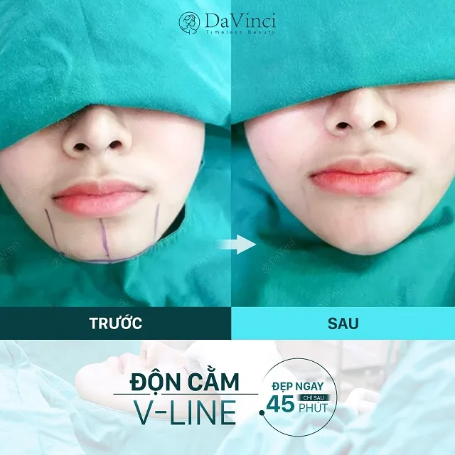 Độn cằm Vline Hàn Quốc có tốt không? Độn cằm Vline ở đâu uy tín? Độn cằm Vline Hàn Quốc có tốt không? Độn cằm Vline ở đâu uy tín?