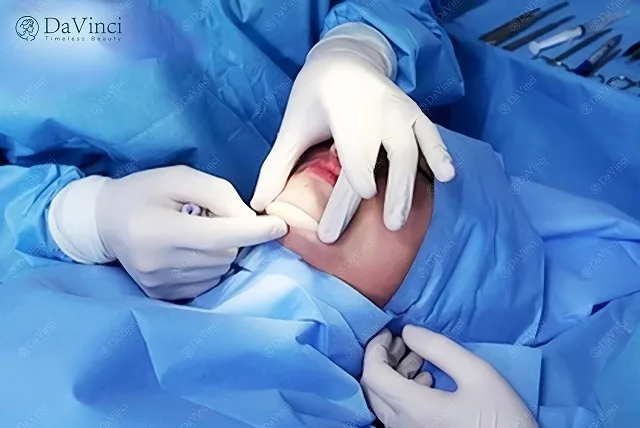 Độn cằm Vline Hàn Quốc có tốt không? Độn cằm Vline ở đâu uy tín? Độn cằm Vline Hàn Quốc có tốt không? Độn cằm Vline ở đâu uy tín?