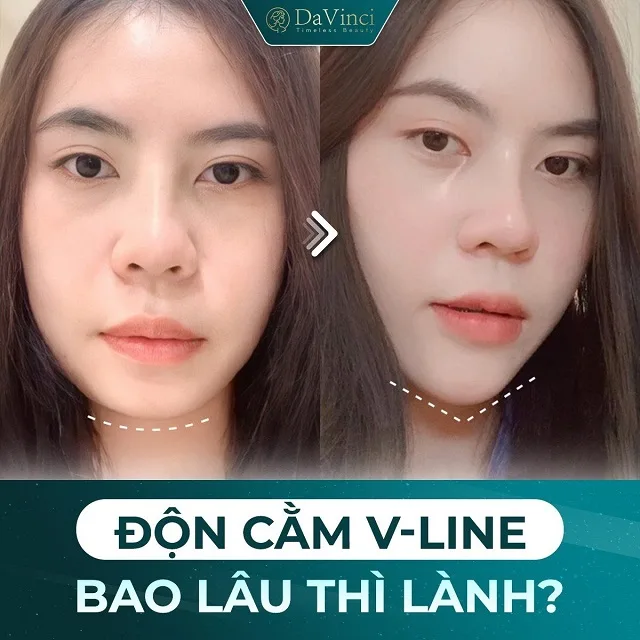 Độn cằm Vline Hàn Quốc có tốt không? Độn cằm Vline ở đâu uy tín? Độn cằm Vline Hàn Quốc có tốt không? Độn cằm Vline ở đâu uy tín?