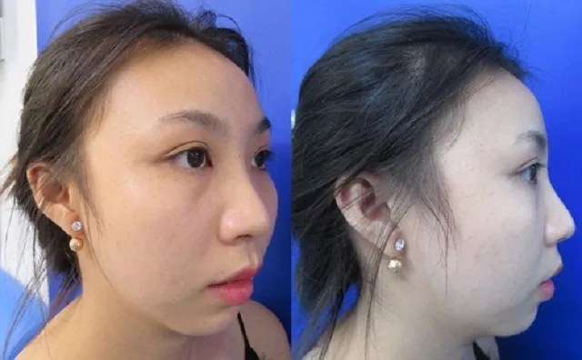Độn cằm lẹm ngắn lệch giá bao nhiêu? Ở đâu uy tín an toàn nhất? 