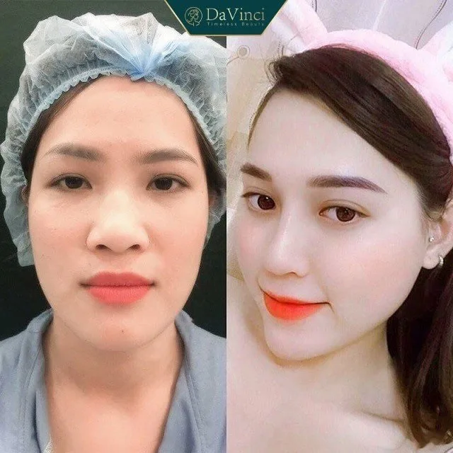 Độn cằm lẹm ngắn lệch giá bao nhiêu? Ở đâu uy tín an toàn nhất? 