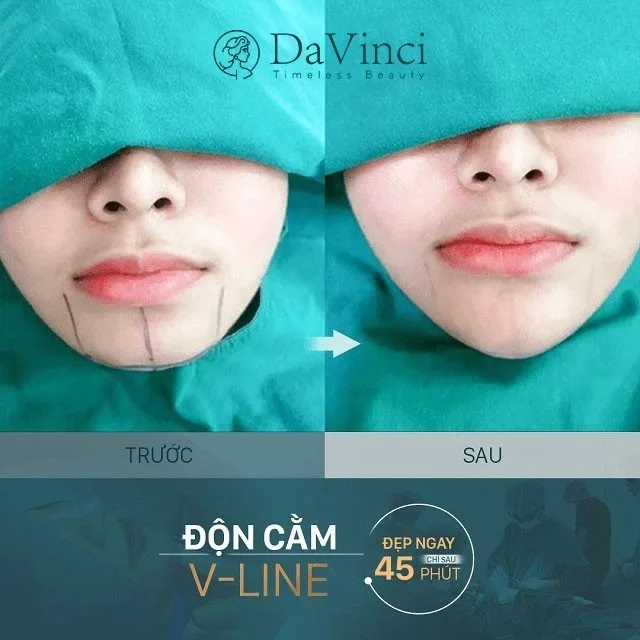 Độn cằm lẹm ngắn lệch giá bao nhiêu? Ở đâu uy tín an toàn nhất? 