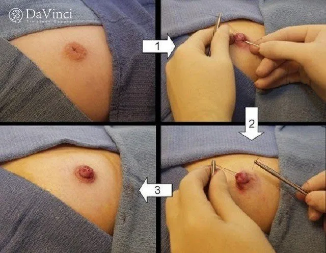 Kéo núm vú tụt ở đâu tốt? Kéo núm vú tụt giá bao nhiêu?