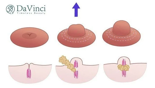 Kéo núm vú tụt ở đâu tốt? Kéo núm vú tụt giá bao nhiêu?