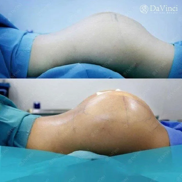 Nâng mông bằng túi độn giá bao nhiêu ? Ở đâu tốt uy tín ?