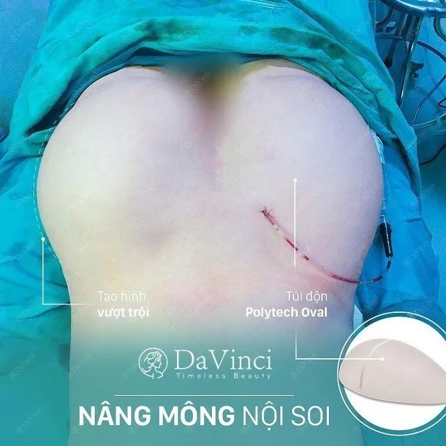 Nâng mông bằng túi độn giá bao nhiêu ? Ở đâu tốt uy tín ?