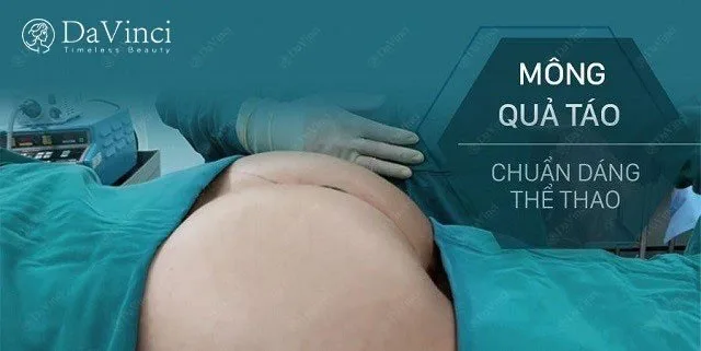 Nâng mông bằng túi độn giá bao nhiêu ? Ở đâu tốt uy tín ?
