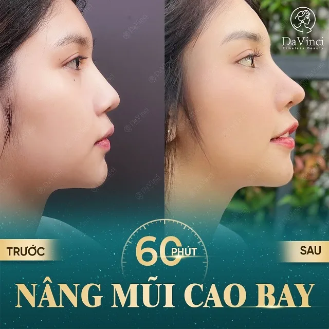 Nâng mũi cao bay có ốt không? Nâng mũi cao bay bao nhiêu tiền?
