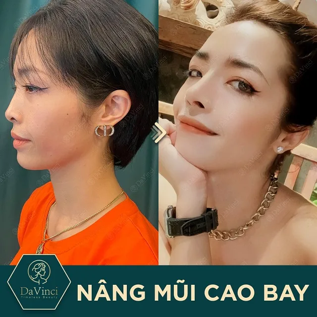 Nâng mũi cao bay có ốt không? Nâng mũi cao bay bao nhiêu tiền?