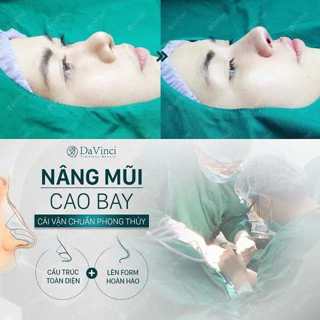 Nâng mũi cao bay có ốt không? Nâng mũi cao bay bao nhiêu tiền?