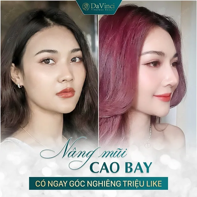 Nâng mũi cao bay có ốt không? Nâng mũi cao bay bao nhiêu tiền?