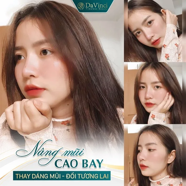 Nâng mũi cao bay có ốt không? Nâng mũi cao bay bao nhiêu tiền?