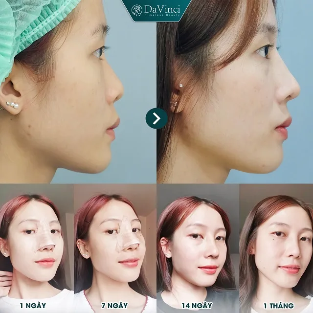Nâng mũi cao bay có ốt không? Nâng mũi cao bay bao nhiêu tiền?