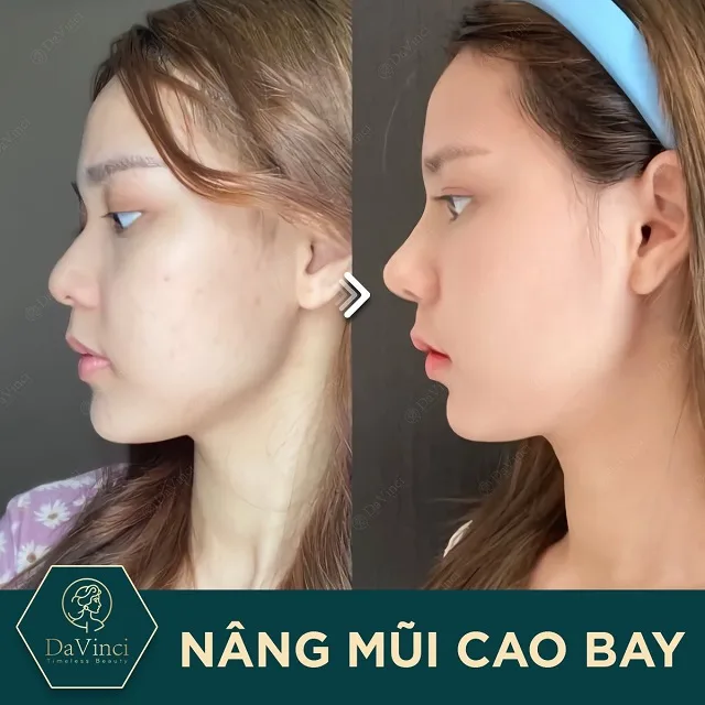 Nâng mũi cao bay có ốt không? Nâng mũi cao bay bao nhiêu tiền?