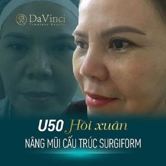 Nâng mũi cấu trúc Surgiform là gì? Giá bao nhiêu? 