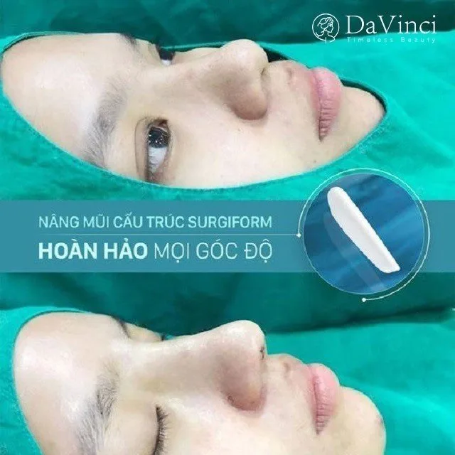 Nâng mũi cấu trúc Surgiform là gì? Giá bao nhiêu? 