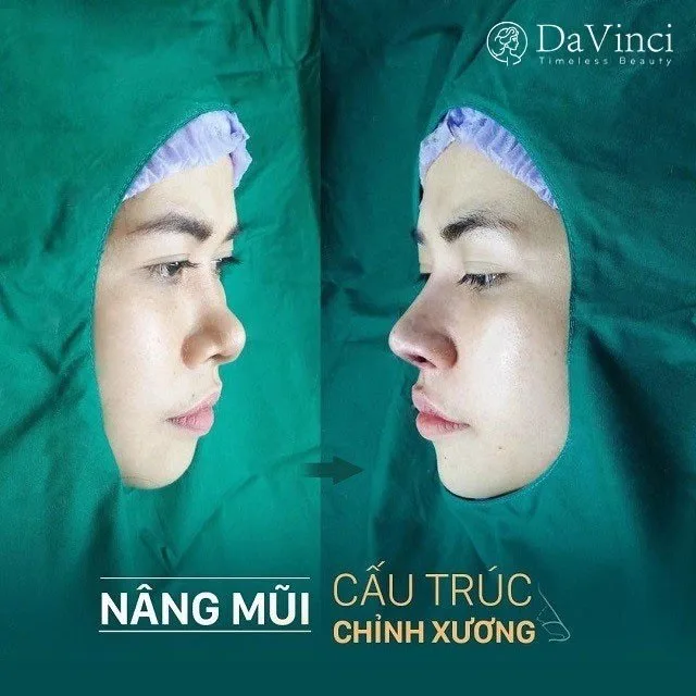 Nâng mũi cấu trúc Surgiform là gì? Giá bao nhiêu? 