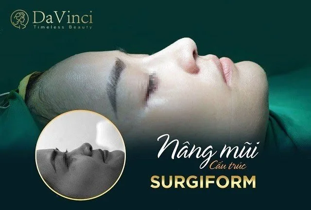 Nâng mũi cấu trúc Surgiform là gì? Giá bao nhiêu? 
