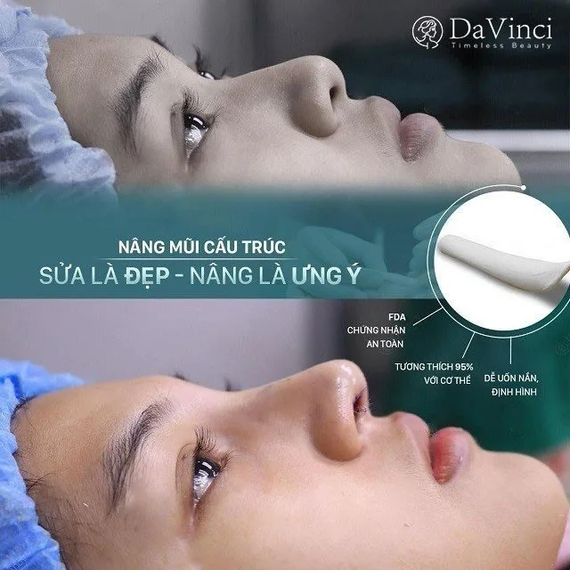 Nâng mũi cấu trúc Surgiform là gì? Giá bao nhiêu? 